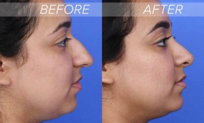 hook nose rhinoplasty before and after 20315 400x243 - What is a rhinoplasty? Its benefits and Procedure