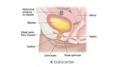 How to Deal with Incontinence during Pregnancy 40858 400x216 - How to Deal with Incontinence during Pregnancy?