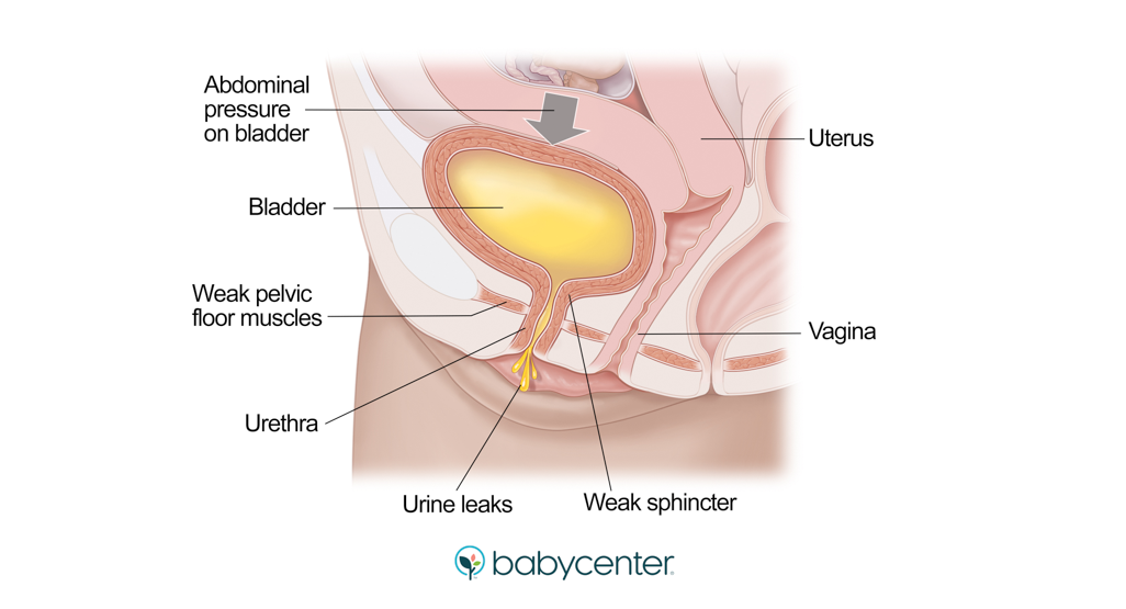 How to Deal with Incontinence during Pregnancy 40858 - How to Deal with Incontinence during Pregnancy?