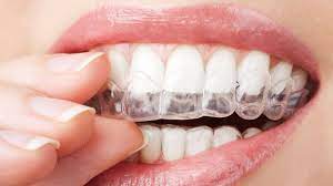 How Long Do - How Long Does Invisalign Take?: Here’s Why Your Dentist May Be Wrong