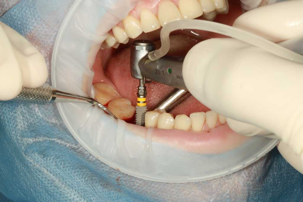 Image 1 scaled - Everything You Need To Know About Dental Implants